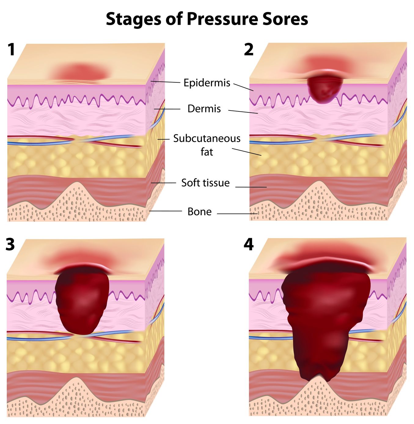 Pressure Sores (Bedsores) Causes, Symptoms, Treatment ...